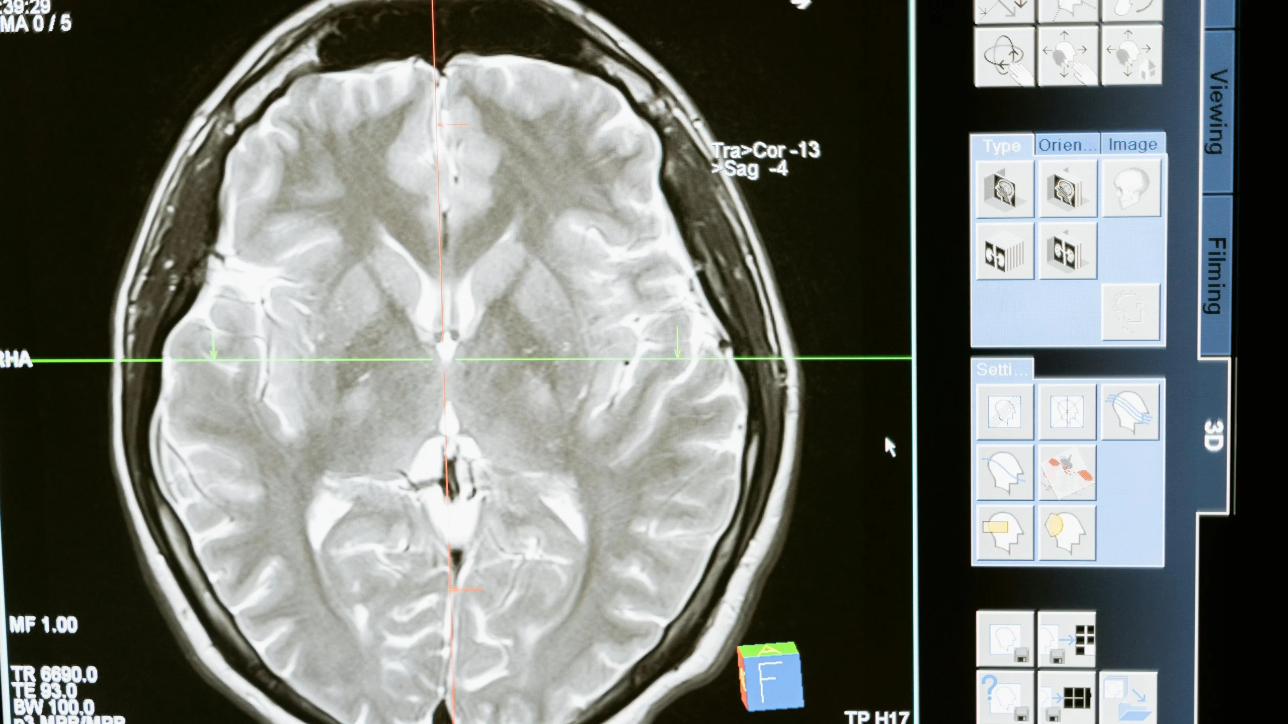 Brain with highlighted dopamine pathways illustrating effects of dopamine supplements